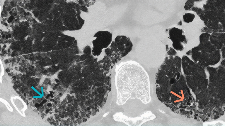 Badanie włókniejącej CTD‑ILD za pomocą obrazowania HRCT