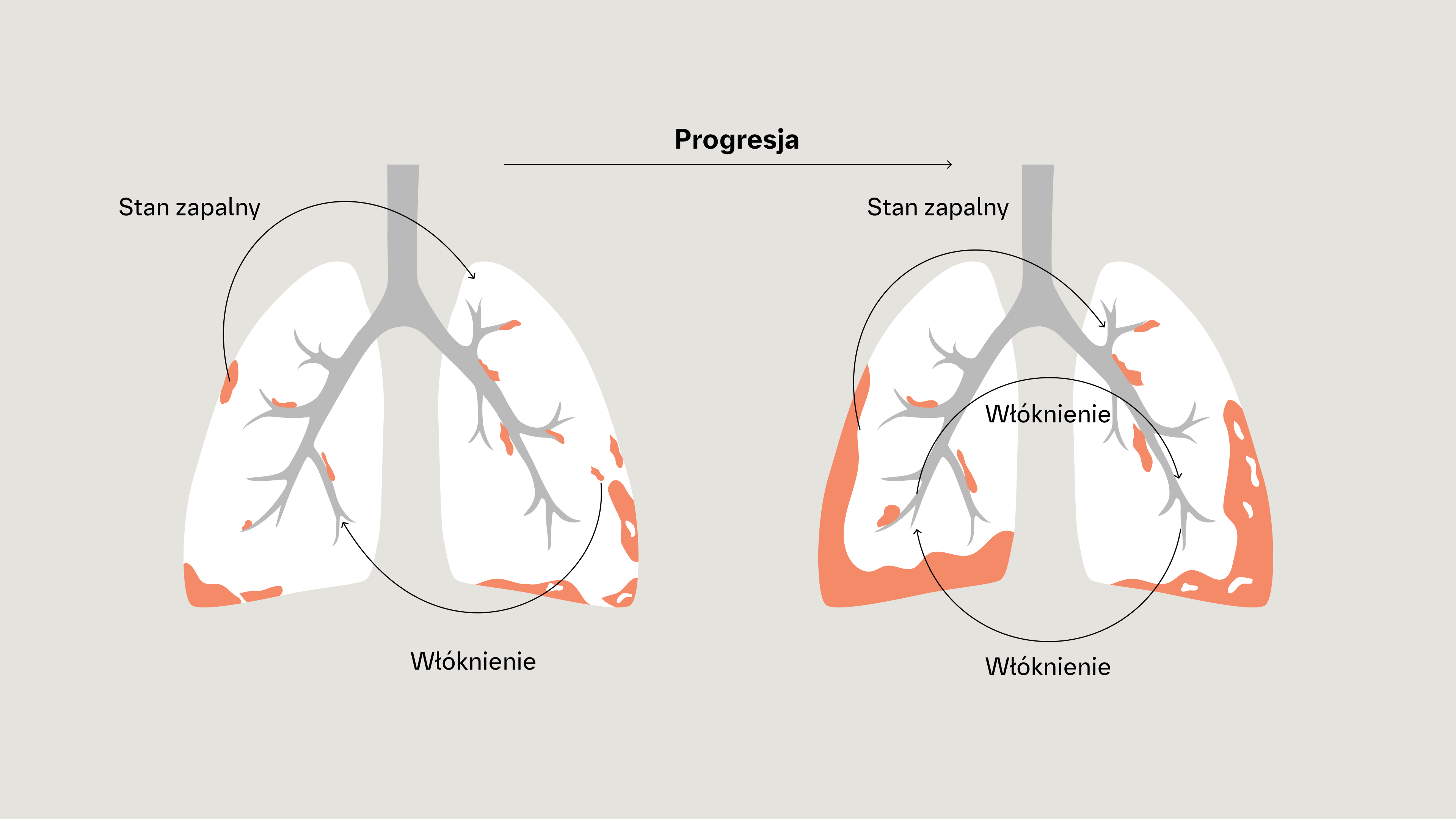 Progresja włóknienia