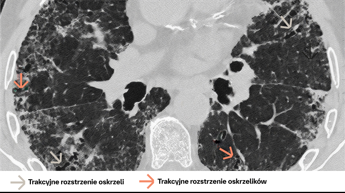 rozstrzenie oskrzeli