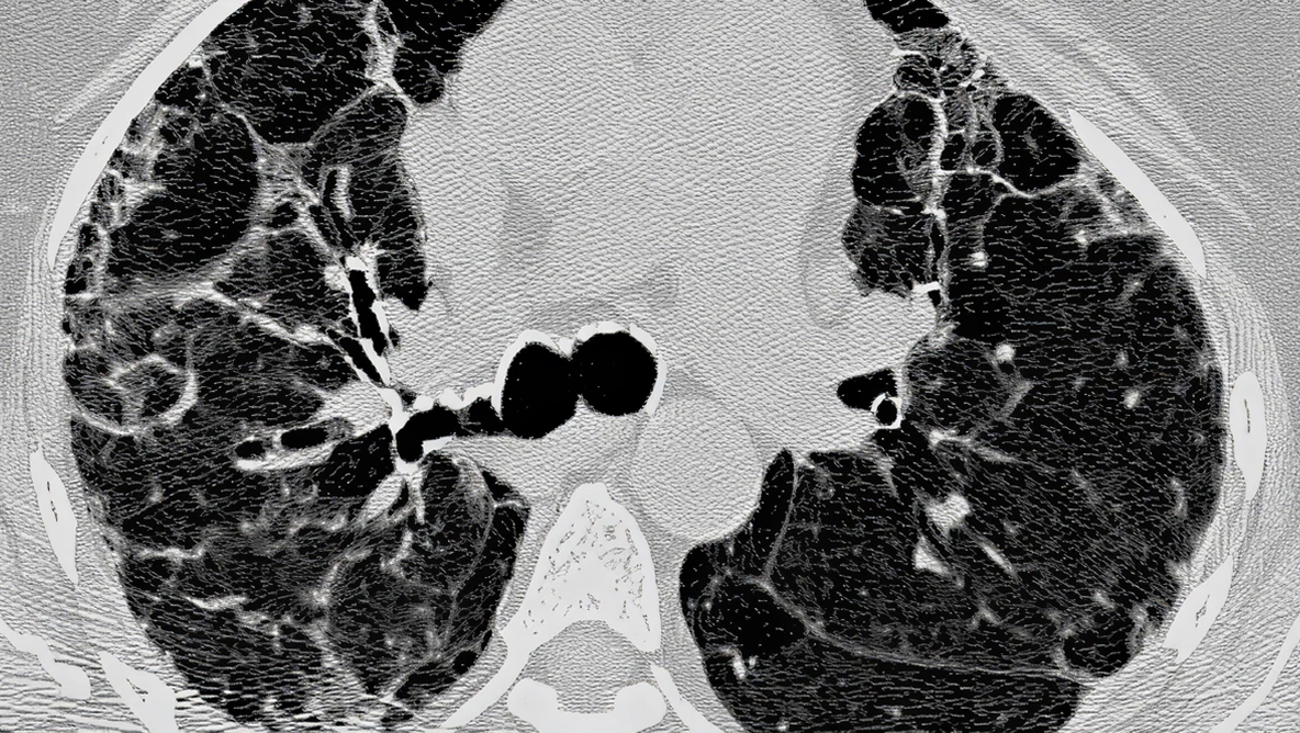 Example of cHP pattern on HRCT